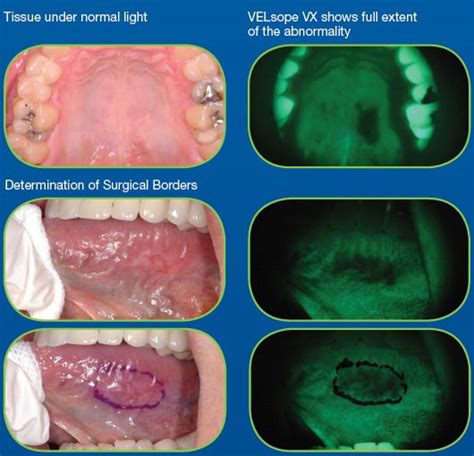 Oral Cancer Screening Tampa Fl The Hyde Park Center For Aesthetic