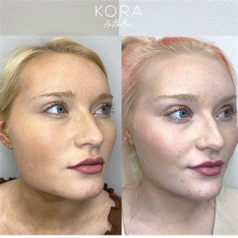 Before And After Botox Photo Gallery Remarkable Results