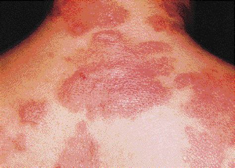 Figure From Urticarial Vasculitis And Dermatomyositis In A Patient