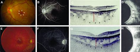 Clinical Findings Of Posterior Scleritis In Case 1 A Fundus Imaging Of