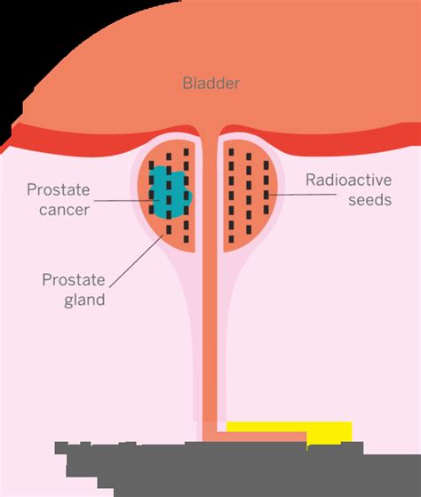 Radical Radiotherapy Prostate Cancer Research