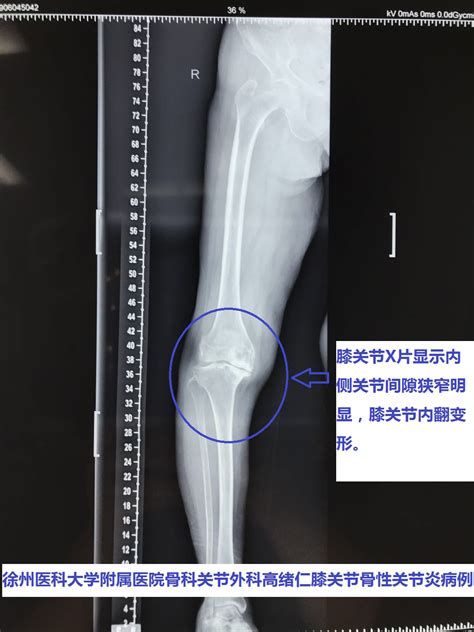 科学网—江苏徐州膝关节骨性关节炎患者有多少？膝骨关节炎的流行病学特点是什么？ 高绪仁的博文