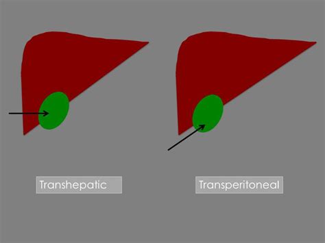 Different access scheme for performing cholecystostomy. | Download Scientific Diagram