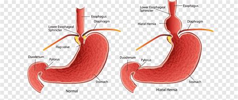 Enfermedad de la disfagia hernia hiatal del estómago texto síntoma