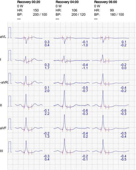 Valuation De L Preuve D Effort Ecg Sympt Mes Tension Art Rielle