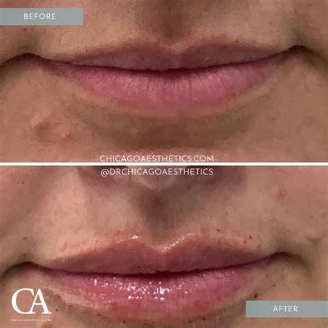 Lip Injections Before After Chicago Aesthetics Medspa