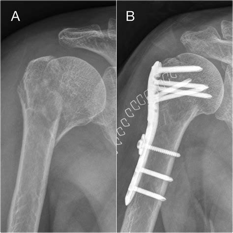 Radiographic And Clinical Results Of Tension Suture Fixation Using Two