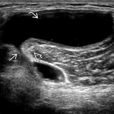 View Baker S Cyst Knee Ultrasound