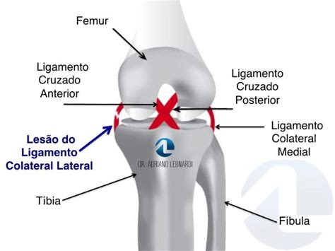 O que é a Lesão do Ligamento Colateral Lateral LCL Especialista do