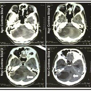 An axial head CT-scan without contrast appeared hypo-dense mass (16.5... | Download Scientific ...