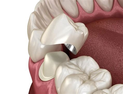 Best Porcelain Crowns in Connecticut - Smile Center CT