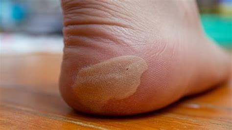 Diabetic Foot Symptoms 6 Signs You Should Not Ignore OnlyMyHealth