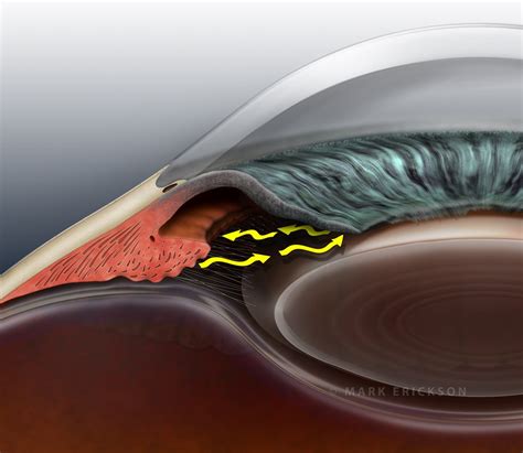 Closed angle glaucoma patient education eye illustration.