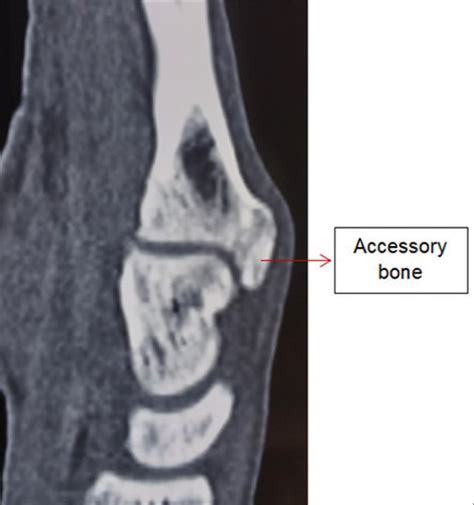 Its not good to be too bossy - Carpal bossing: A case report with ...