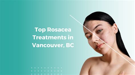 Top Rosacea Treatments In Vancouver Bc Dr E Dermatology