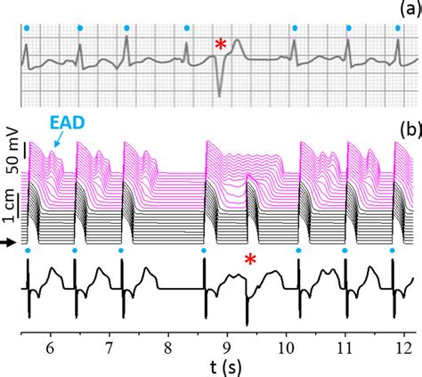 PVCs in the heart. (a) An ECG from a real patient with a PVC in the ...