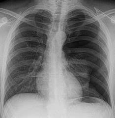 Pneumothorax Treatment