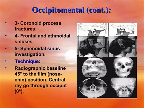 Extra Oral Radiology Techniques Ii Ppt