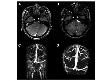 Mri Suggested A Right Side Sigmoid Sinus Thrombosis B A Slightly