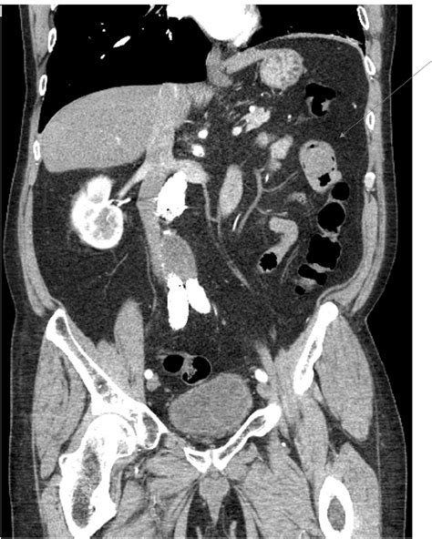 Figure 1 From A Case Of Jejuno Jejunal Intussusception Caused By