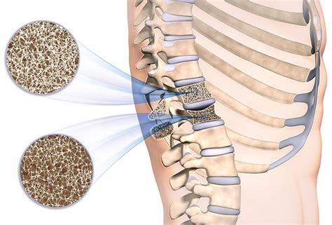 Osteoporotische Wirbelbrüche Kantonsspital Winterthur KSW