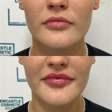 Pin On Lip Filler Lip Fillers Lips Filler