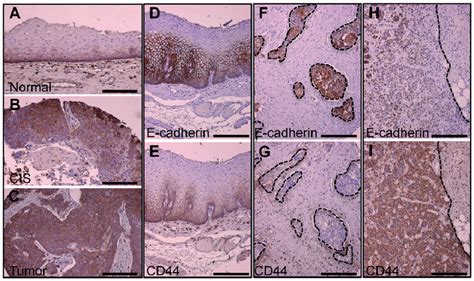 Inverse Correlation Of E Cadherin And Cd44 Expression In Primary Human Download Scientific