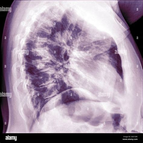 Chest X Ray Of A 57 Year Old Female Patient With Signs Of Pneumonia In