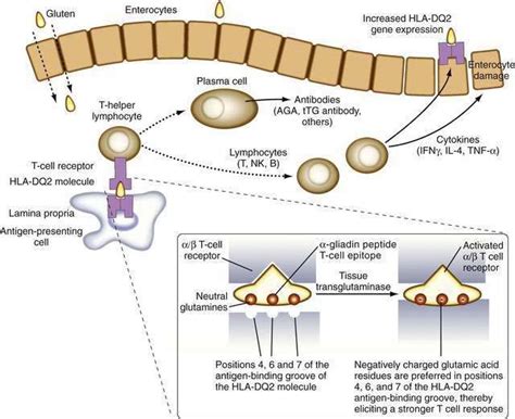 Celiac Disease And Refractory Celiac Disease Abdominal Key