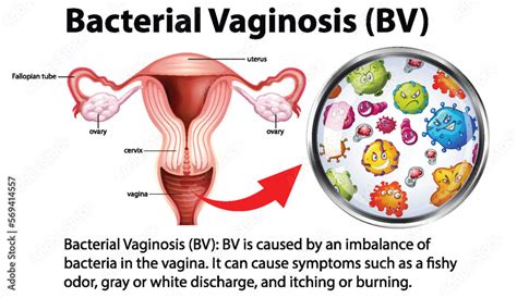 Bacterial Vaginosis Bv Infographic With Explanation Stock Vector Adobe Stock