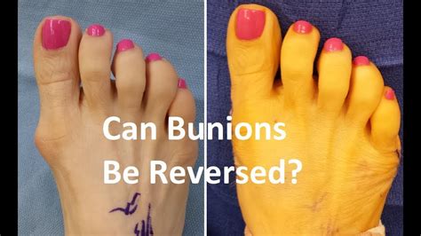 Can Bunions Be Reversed Without Surgery Home Guide YouTube