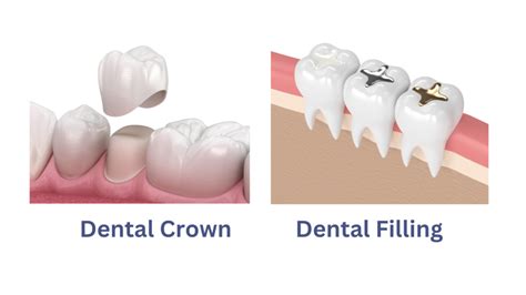 Tooth Filling vs Crown | Dr.Quadri Choosing Dental Solutions