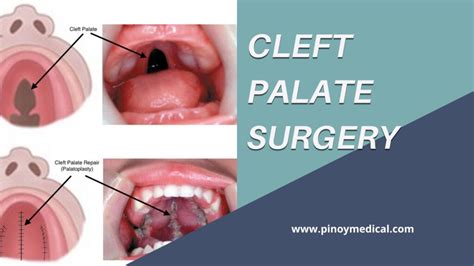 Cleft Palate Surgery Price in the Philippines 2025 — PinoyMedical