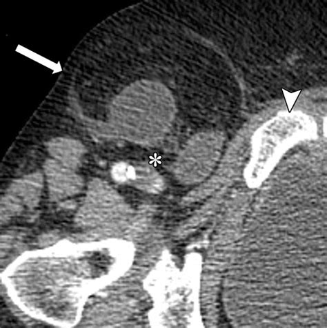 From Inguinal Hernias To Spermatic Cord Lipomas Pearls Pitfalls And