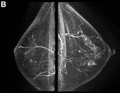 L IRM de contraste pour évaluer le risque de cancer du sein secondaire