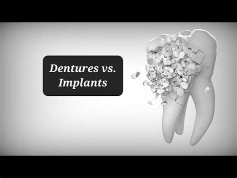 Dentures Vs Dental Implants Why I Chose Dentures YouTube