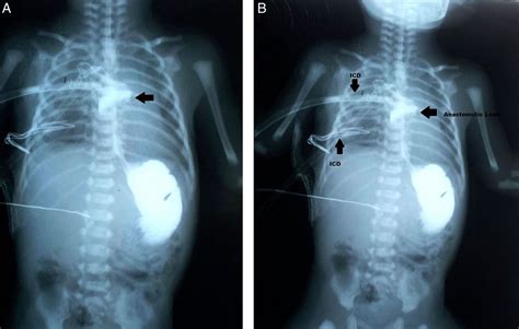 Tracheoesophageal Fistula X Ray