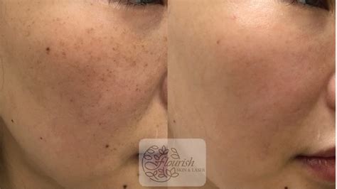 Laser Pigmentation Removal Flourish Skin And Laser Studio