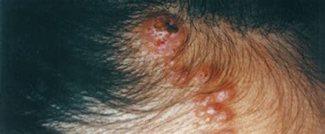 Wart On Scalp