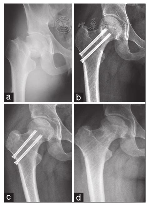 Subcapital Femoral Neck Fracture