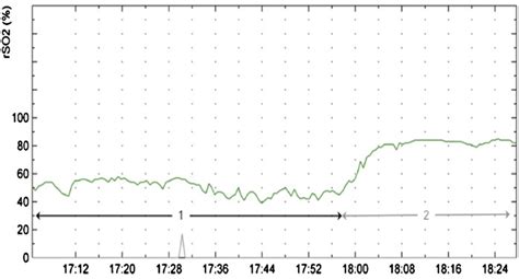 Cerebral Near Infrared Spectroscopy Measurement During CPR Of A