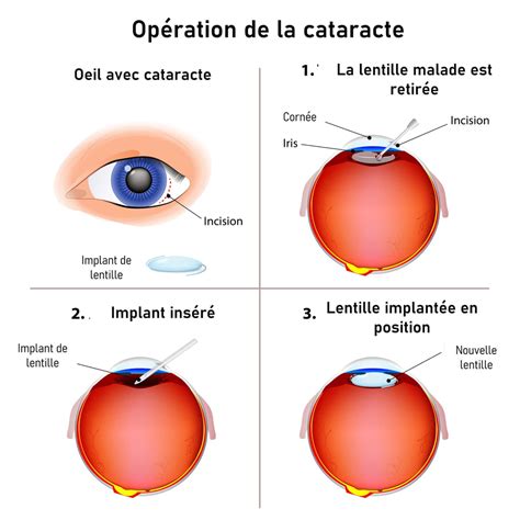 Op Ration De La Cataracte Laser Implant Comment