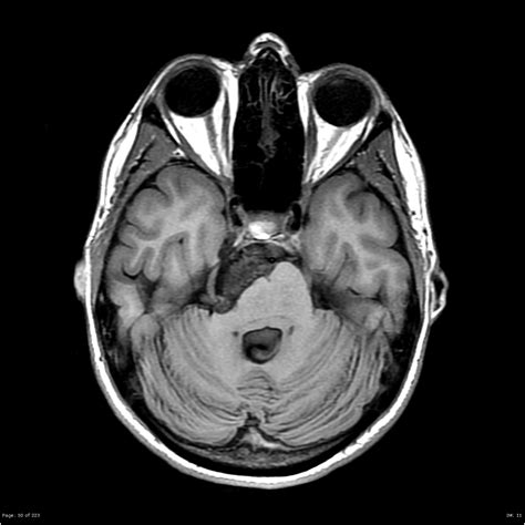 Epidermoid Cyst Cerebellopontine Angle Image