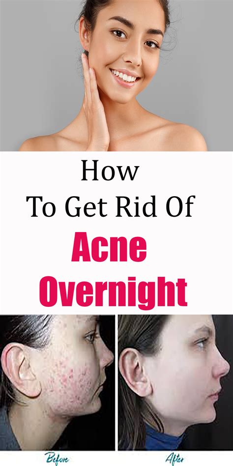 How To Get Rid Of Acne Overnight