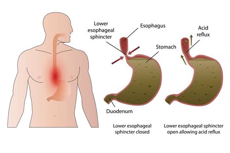 Acid Leaks From Stomach To Esophagus