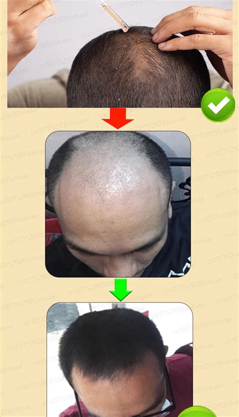 Hair Growth Oil Effective Baldness Repair Hereditary Hair Loss