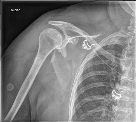 Scapula Fractures – Core EM