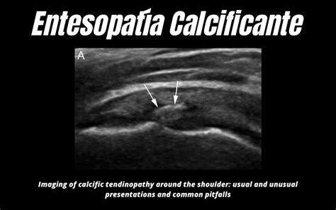 Calcificaciones en el hombro Ecografía Tempo Formación