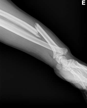 Galeazzi fracture-dislocation | Radiology Case | Radiopaedia.org