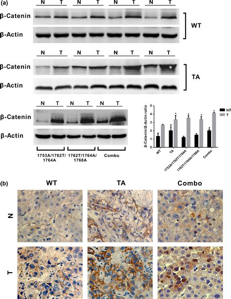 Hbx Mutations Promote Hepatoma Cell Migration Through The Wnt β‐catenin